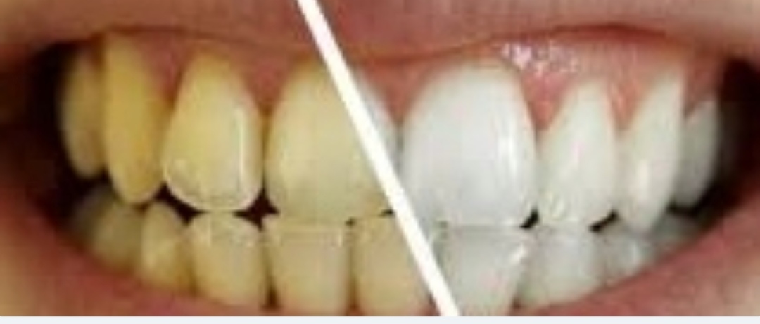 [Santé et Bien-être] Pourquoi les dents se jaunissent ?
